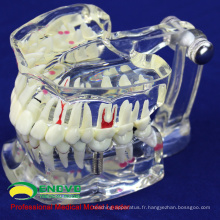 VENDEZ 12567 Dentaire Transparent de taille de la vie avec la dent d&#39;implant